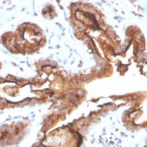 Formalin-fixed, paraffin-embedded human breast carcinoma stained with MUC-1 Recombinant Rabbit Monoclonal Antibody (MUC1/4416R).