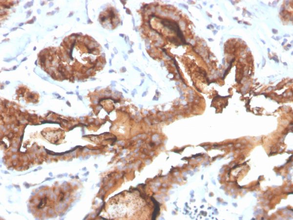 Formalin-fixed, paraffin-embedded human breast carcinoma stained with MUC-1 Recombinant Rabbit Monoclonal Antibody (MUC1/4416R).