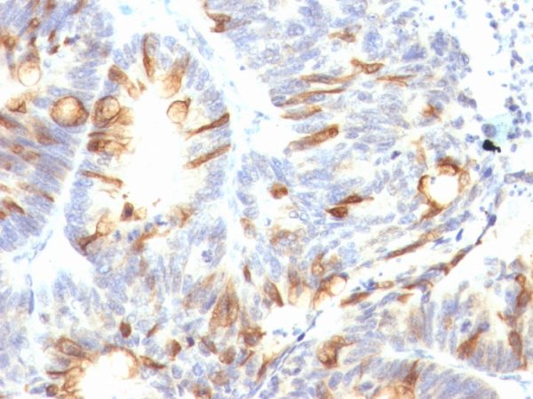 Formalin-fixed, paraffin-embedded human colon carcinoma stained with MUC2 Mouse Monoclonal Antibody (CCP58).