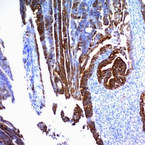 Formalin-fixed, paraffin-embedded human colon carcinoma stained with MUC2 Mouse Monoclonal Antibody (SPM296).
