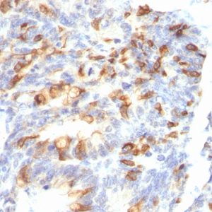 Formalin-fixed, paraffin-embedded human colon carcinoma stained with MUC2 Mouse Monoclonal Antibody (MLP/842).