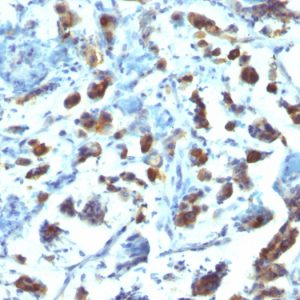 Formalin-fixed, paraffin-embedded human Gastric Carcinoma stained with MUC3 Monoclonal Antibody (SPM200).