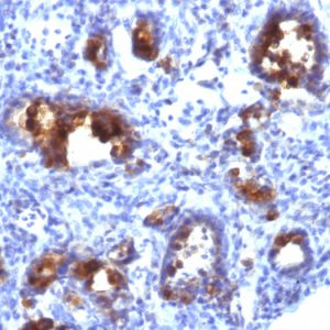 Formalin-fixed, paraffin-embedded human Gastric Carcinoma stained with MUC3 Monoclonal Antibody (MUC3/1154).