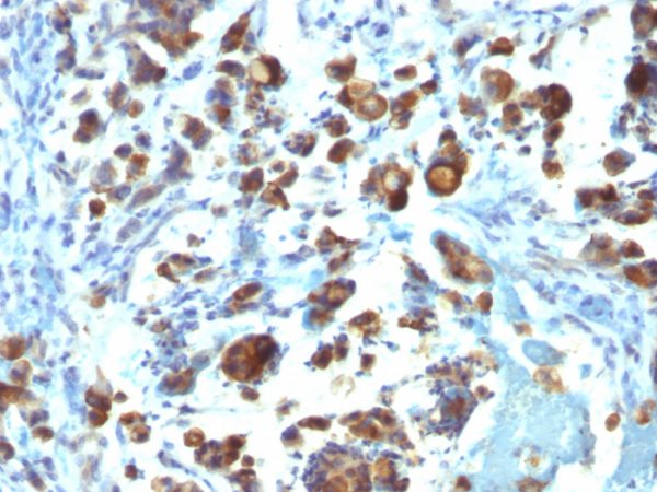 Formalin-fixed, paraffin-embedded human Gastric Carcinoma stained with MUC3 Monoclonal Antibody (MUC3/1154).