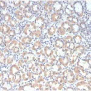 Formalin-fixed, paraffin-embedded human gastric carcinoma stained with MUC3 Recombinant Mouse Monoclonal Antibody (rMUC3/1154). HIER: Tris/EDTA, pH9.0, 45min. 2°C: HRP-polymer, 30min. DAB, 5min.