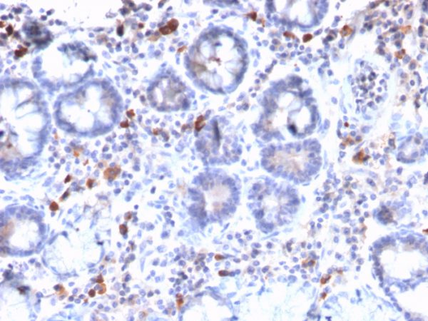 Formalin-fixed, paraffin-embedded human Gastric Carcinoma stained with MUC3 Rabbit Recombinant Monoclonal Antibody (MUC3/2992R).