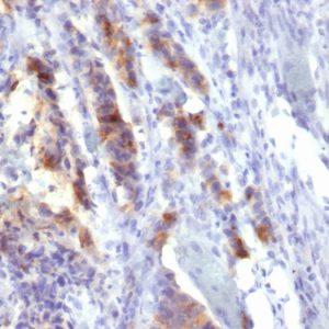 Formalin-fixed, paraffin-embedded human Gastric Carcinoma stained with MUC5AC Monoclonal Antibody (SPM488).