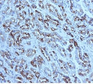 Formalin-fixed, paraffin-embedded human gastric carcinoma stained with MUC6 Mouse Monoclonal Antibody (CLH5). Courtesy of Dr. Leonor David, IPATIMUP and Medical Faculty, University of Porto, Portugal.