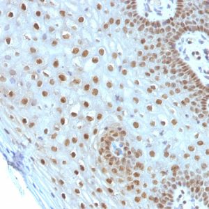 Formalin-fixed, paraffin-embedded human Cervical Carcinoma stained with c-Myc Monoclonal Antibody (MYC275).