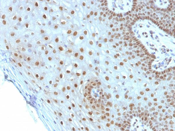 Formalin-fixed, paraffin-embedded human Cervical Carcinoma stained with c-Myc Monoclonal Antibody (MYC275).