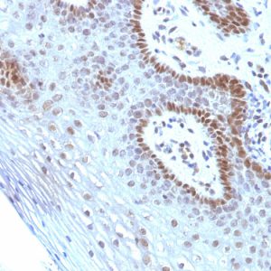 Formalin-fixed, paraffin-embedded human Cervical Carcinoma stained with c-Myc Monoclonal Antibody (SPM237).