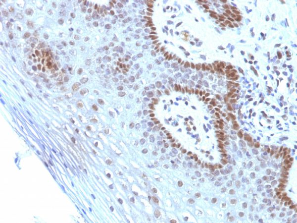 Formalin-fixed, paraffin-embedded human Cervical Carcinoma stained with c-Myc Monoclonal Antibody (SPM237).