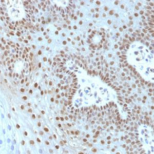 Formalin-fixed, paraffin-embedded human Cervical Carcinoma stained with c-myc Monoclonal Antibody (MYC275 + MYC909).