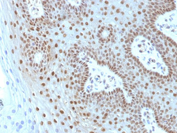 Formalin-fixed, paraffin-embedded human Cervical Carcinoma stained with c-myc Monoclonal Antibody (MYC275 + MYC909).