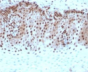 Formalin-fixed, paraffin-embedded human cervical carcinoma stained with c-Myc Recombinant Mouse Monoclonal Antibody (rMYC909). HIER: Tris/EDTA, pH9.0, 45min. 2 °: HRP-polymer, 30min. DAB, 5min.