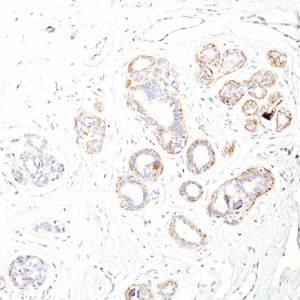 Formalin-fixed, paraffin-embedded human Breast Carcinoma stained with SM-MHC Monoclonal Antibody (ID8).