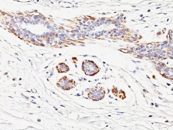 Formalin-fixed, paraffin-embedded human Breast Carcinoma stained with SM-MHC Mouse Monoclonal Antibody (MYH11/923).