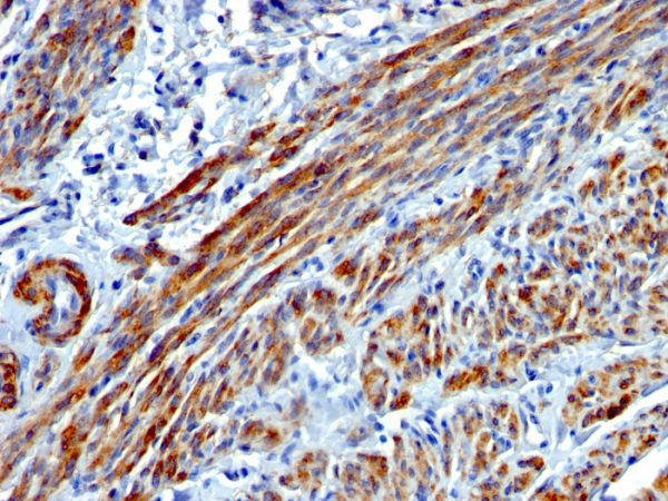 Formalin-fixed, paraffin-embedded human Leiomyosarcoma stained with SM-MHC Mouse Monoclonal Antibody (MYH11/923).
