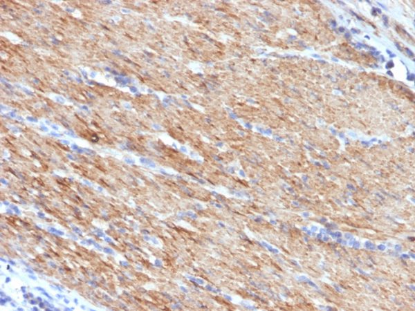 Formalin-fixed, paraffin-embedded human Colon Carcinoma stained with SM-MHC Mouse Monoclonal Antibody (MYH11/923).