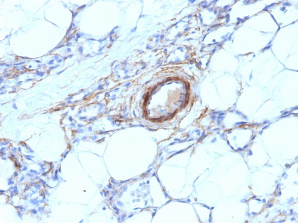 Formalin-fixed, paraffin-embedded human Angiosarcoma stained with SM-MHC Mouse Monoclonal Antibody (MYH11/923).