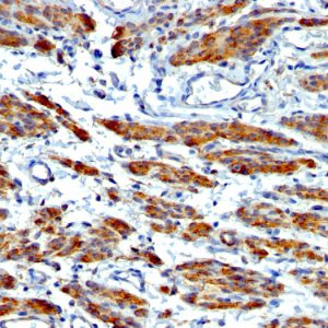 Formalin-fixed, paraffin-embedded human Leiomyosarcoma stained with SM-MHC Monoclonal Antibody (MYH11/923 + SMMS-1).