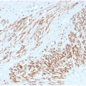 Formalin-fixed, paraffin-embedded human leiomyosarcoma stained with SM-MHC Recombinant Rabbit Monoclonal Antibody (MYH11/4337R).