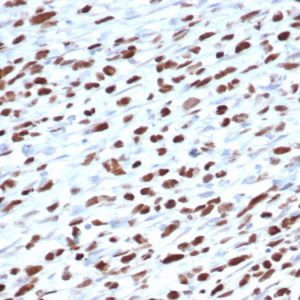 Formalin-fixed, paraffin-embedded human rhabdomyosarcoma stained with MyoD1 Mouse Monoclonal Antibody (5.8).