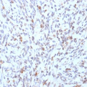 Formalin-fixed, paraffin-embedded human Rhabdomyosarcoma stained with MyoD1 Mouse Recombinant Monoclonal Antibody (rMYD712).