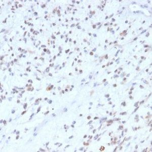 Formalin-fixed, paraffin-embedded human rhabdomyosarcoma stained with MyoD1 Recombinant Rabbit Monoclonal Antibody (MYOD1/2075R).