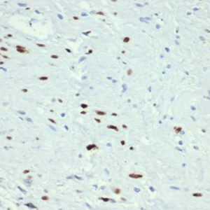 Formalin-fixed, paraffin-embedded human rhabdomyosarcoma stained with MyoD1 Recombinant Rabbit Monoclonal Antibody (MYOD1/3418R) at 2ug/ml in PBS. HIER: Tris/EDTA pH9.0; 95°C/45min. 2°CAb: HRP-Poly:30min. DAB:5min.