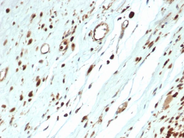 Formalin-fixed, paraffin-embedded human rhabdomyosarcoma stained with MyoD1 Recombinant Rabbit Monoclonal Antibody (MYOD1/3418R) at 2ug/ml in PBS. HIER: Tris/EDTA pH9.0; 95°C/45min. 2 °Ab: HRP-Poly:30min. DAB:5min.