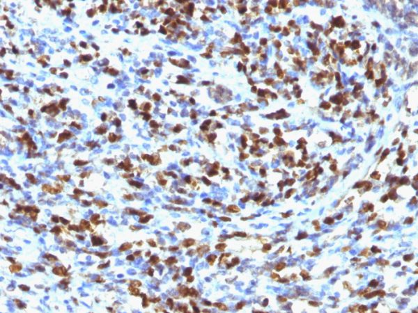 Formalin-fixed, paraffin-embedded human Rhabdomyosarcoma stained with Myogenin Mouse Monoclonal Antibody (MGN185).