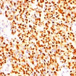 Formalin-fixed, paraffin-embedded human Rhabdomyosarcoma stained with Myogenin Mouse Monoclonal Antibody (SPM144)
