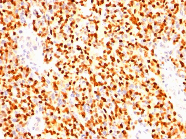 Formalin-fixed, paraffin-embedded human Rhabdomyosarcoma stained with Myogenin Mouse Monoclonal Antibody (SPM144)