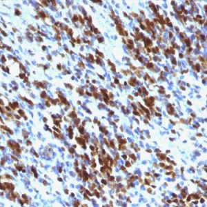 Formalin-fixed, paraffin-embedded human Rhabdomyosarcoma stained with Myogenin Mouse Monoclonal Antibody (MGN185+F5D)