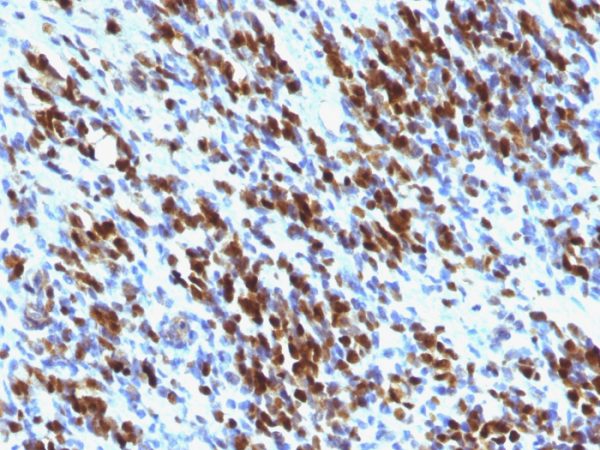 Formalin-fixed, paraffin-embedded human Rhabdomyosarcoma stained with Myogenin Mouse Monoclonal Antibody (MGN185+F5D)