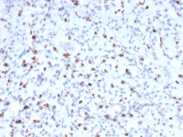 Formalin-fixed, paraffin-embedded human Rhabdomyosarcoma stained with Myogenin Mouse Monoclonal Antibody (MYOG/2660)
