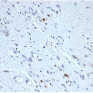 Formalin-fixed, paraffin-embedded human Rhabdomyosarcomastained with Myogenin Recombinant Mouse Monoclonal Antibody (rMYOG/6297). HIER: Tris/EDTA, pH9.0, 45min. 2°C: HRP-polymer, 30min. DAB, 5min.