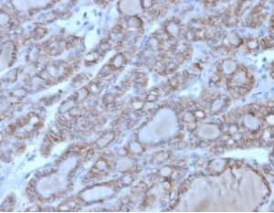 Formalin-fixed, paraffin-embedded human thyroid stained with CD56 Mouse Monoclonal Antibody (123A8). HIER: Tris/EDTA, pH9.0, 45min. 2 °: HRP-polymer, 30min. DAB, 5min.