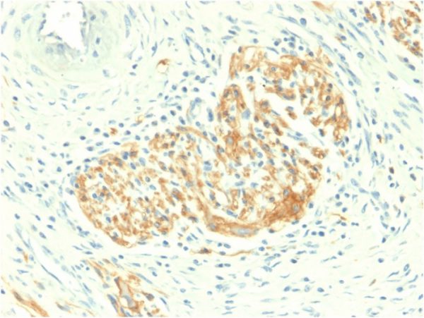 Formalin-fixed, paraffin-embedded human Colon Carcinoma stained with CD56 Rabbit Recombinant Monoclonal Antibody (NCAM1/2217R).