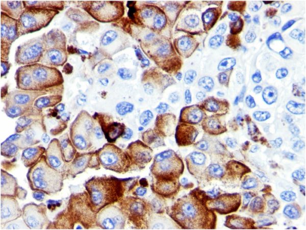 Formalin-fixed, paraffin-embedded human Melanoma stained with NGFR Mouse Monoclonal Antibody (NGFR5).