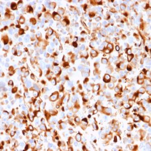 Formalin-fixed, paraffin-embedded human melanoma stained with NGFR Recombinant Mouse Monoclonal Antibody (rNGFR/1965).