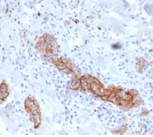 Formalin-fixed, paraffin-embedded human melanoma stained with NGFR Mouse Monoclonal Antibody (NGFR/4919) at 2ug/ml. HIER: Tris/EDTA, pH9.0, 45min. 2 °: HRP-polymer, 30min. DAB, 5min.