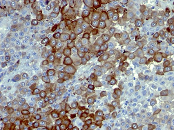 Formalin-fixed, paraffin-embedded human Melanoma stained with NGFR Monoclonal Antibody (NTR/912).