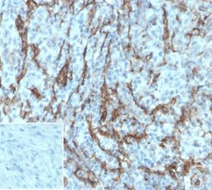 Formalin-fixed, paraffin-embedded human melanoma stained with NGFR Rabbit Recombinant Monoclonal Antibody (NGFR/1997R). Inset: PBS instead of primary antibody; secondary only negative control.