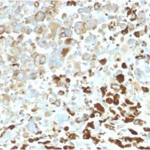 Formalin-fixed, paraffin-embedded human Melanoma stained with NGFR Rabbit Recombinant Monoclonal Antibody (NGFR/2550R).