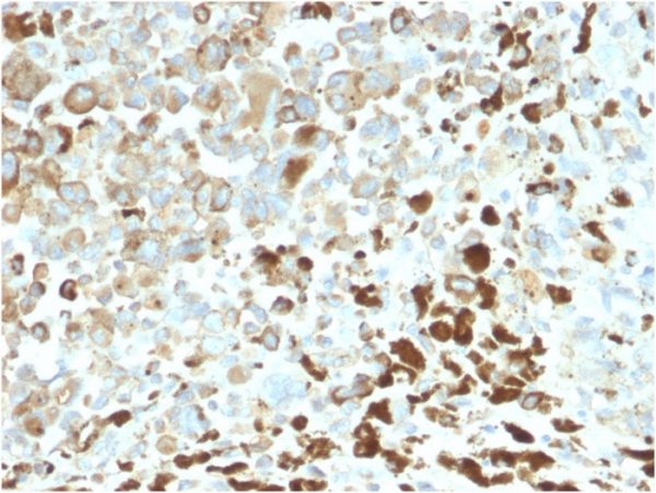 Formalin-fixed, paraffin-embedded human Melanoma stained with NGFR Rabbit Recombinant Monoclonal Antibody (NGFR/2550R).