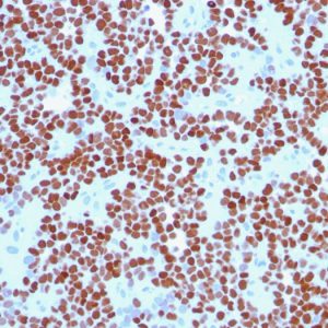 Formalin-fixed, paraffin-embedded human Ewing&apos;s Sarcoma stained with NKX2.2 Mouse Monoclonal Antibody (NX2/294).