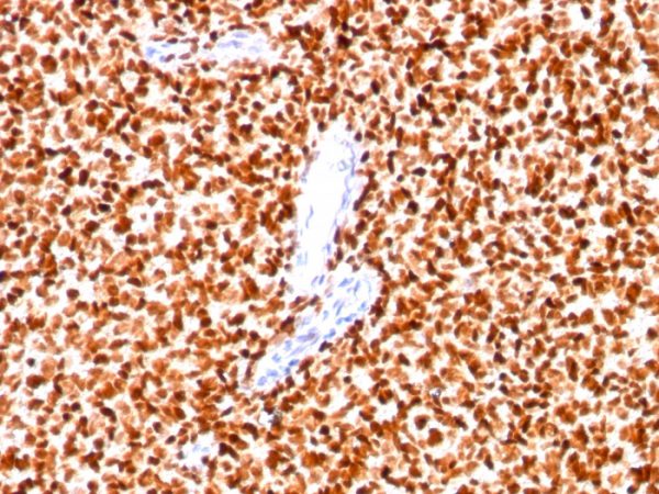 Formalin-fixed, paraffin-embedded human Ewing&apos;s sarcoma stained with NKX2.2 Monoclonal Antibody (SPM564).