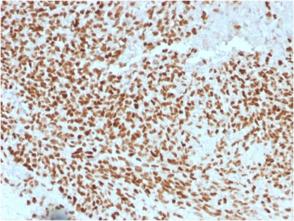 Formalin-fixed, paraffin-embedded human Ewing&apos;s Sarcoma stained with NKX2.2 Mouse Monoclonal Antibody (NX2/1523).